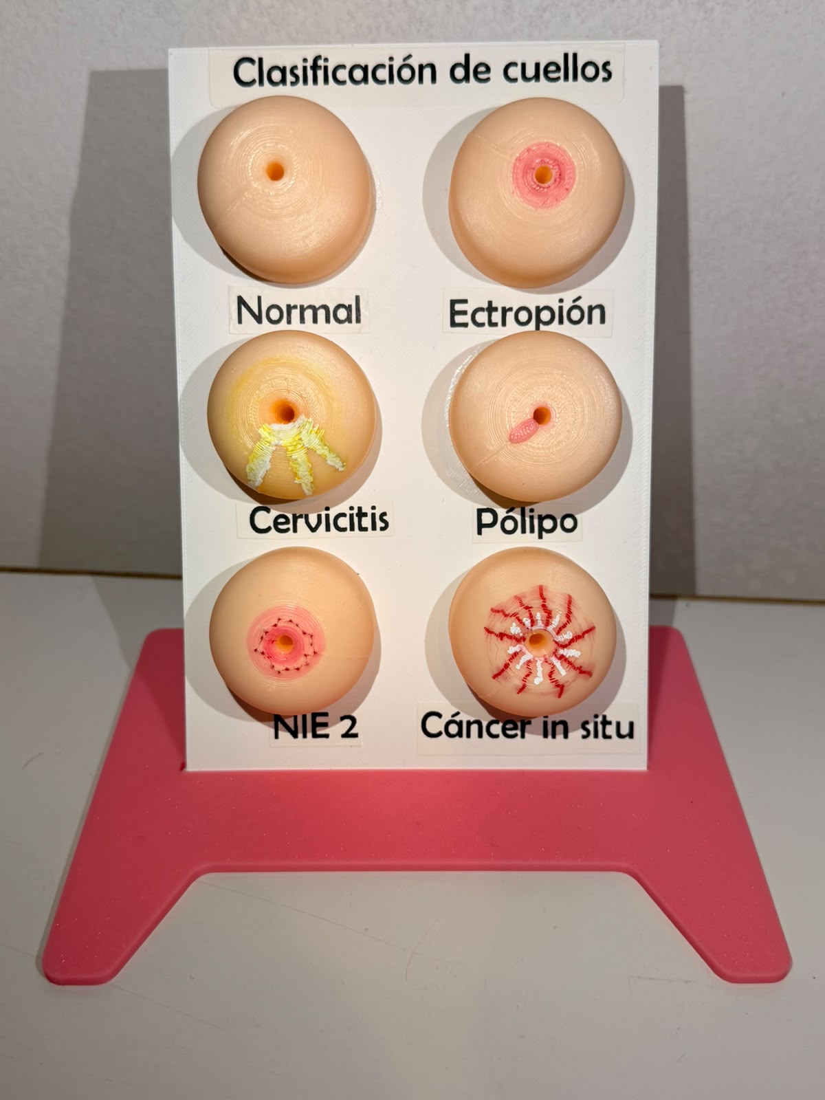 Modelo educativo 3D de cuello uterino: clasificación y alteraciones